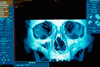 MRI