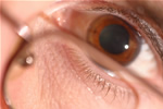 Eye